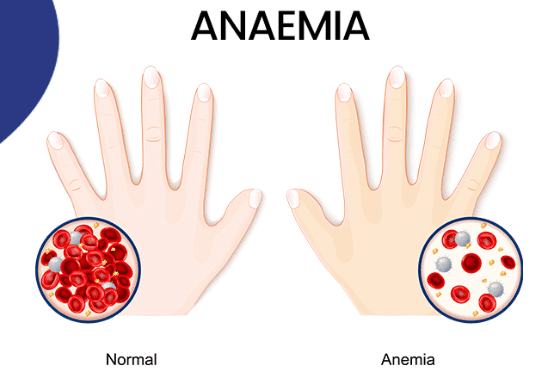 Anemia: Symptoms, Causes And Treatments of Anemia