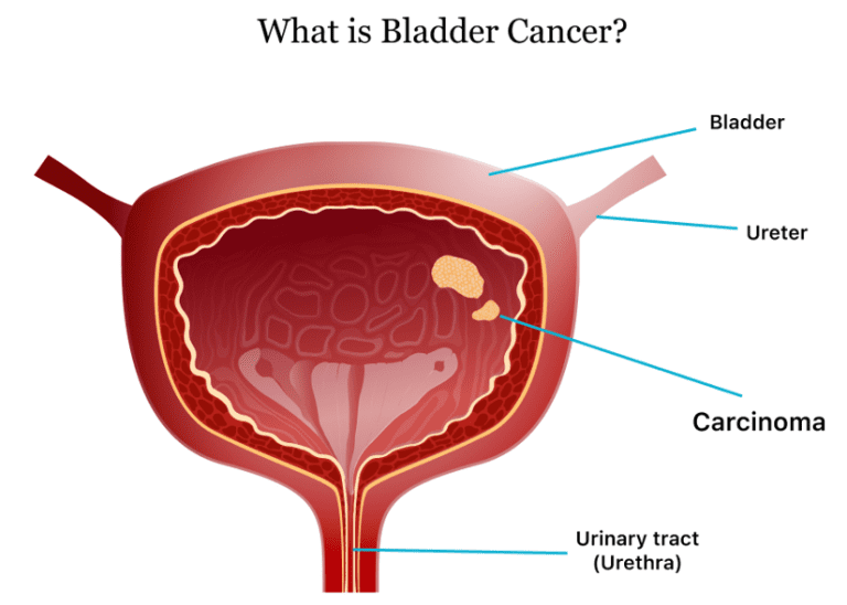 Bladder Cancer: Treatment, Sign and Symptoms of Bladder Cancer