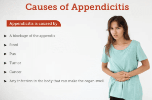 Appendicitis Causes 