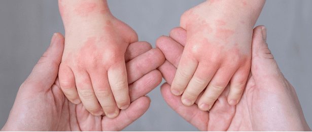 Eczema or Atopic Dermatitis: Eczema Symptoms, Causes and Treatment