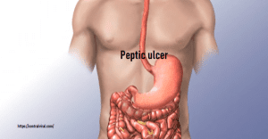 Peptic ulcer