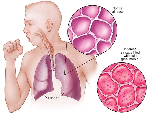 Pneumonia: Symptoms of Pneumonia, Causes, Treatment and More you Need to Know