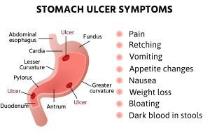 Stomach Ulcer Symptoms