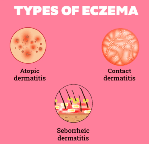 Types of Eczema