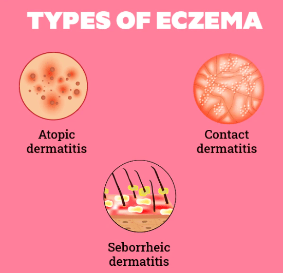 Eczema or Atopic Dermatitis: Eczema Symptoms, Causes and Treatment ...