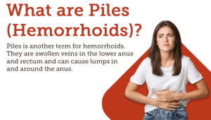 What Are Hemorrhoids or Piles