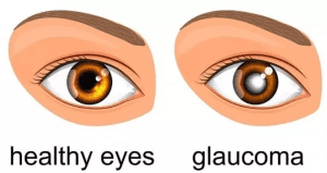 What Is Glaucoma