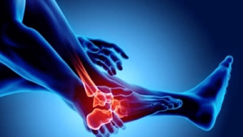 Arthritis: Types of Arthritis, Symptoms and Treatment