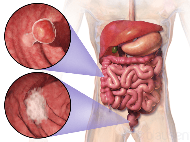 colon cancer