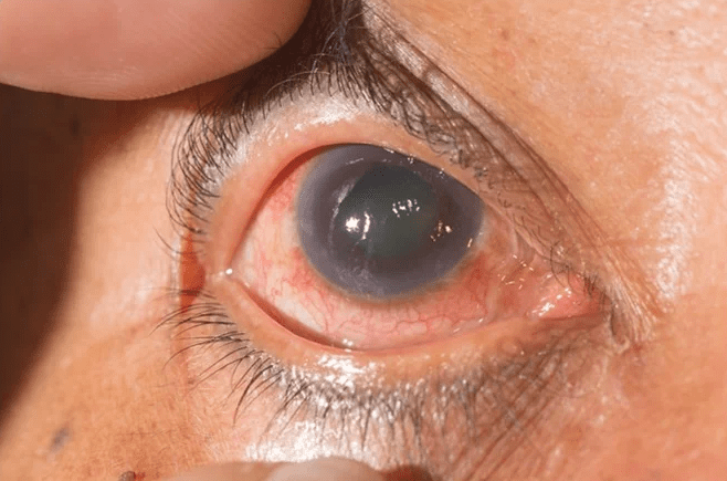 Glaucoma Symptoms, Causes, Test, And Treatment