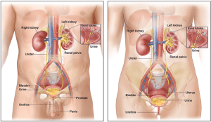 male & female bladder cancer